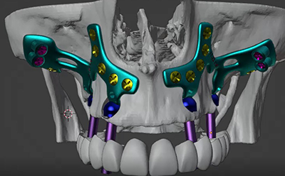 Implantes personalizados ImplanTize