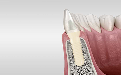 Implantes de Zircónia Patent